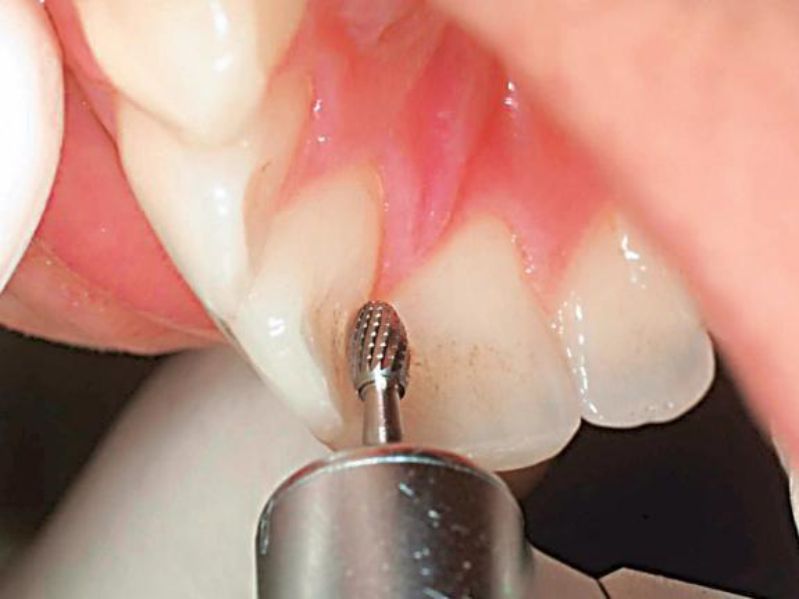 Chỉnh sửa mô cứng trong một số thủ thuật