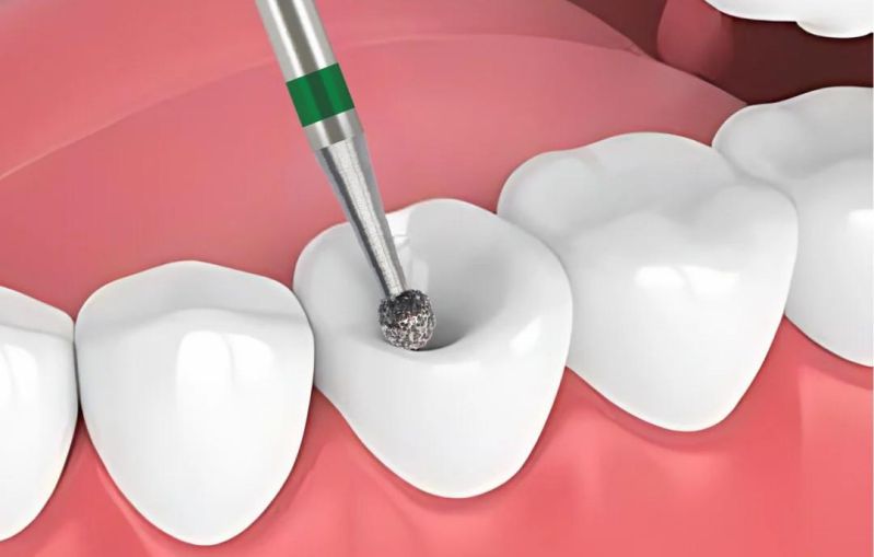 Tạo và mở rộng xoang trám