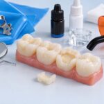 Minh họa bong miếng trám do lỗi kỹ thuật dán và những sai sót hay gặp