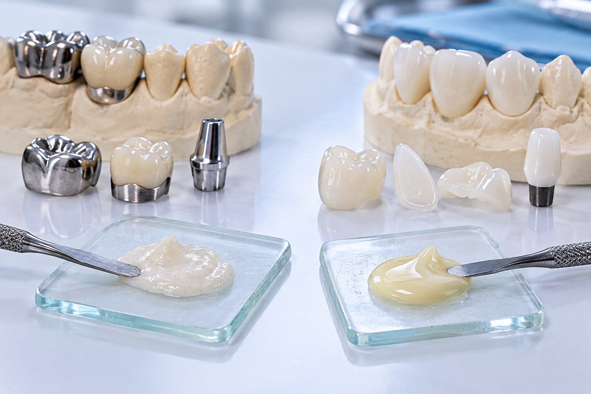 Minh họa bảng so sánh glass ionomer và resin cement